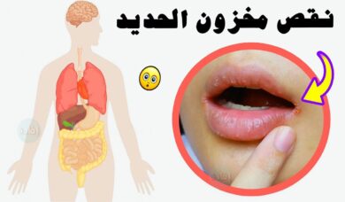 أعراض نقص الحديد في الجسم