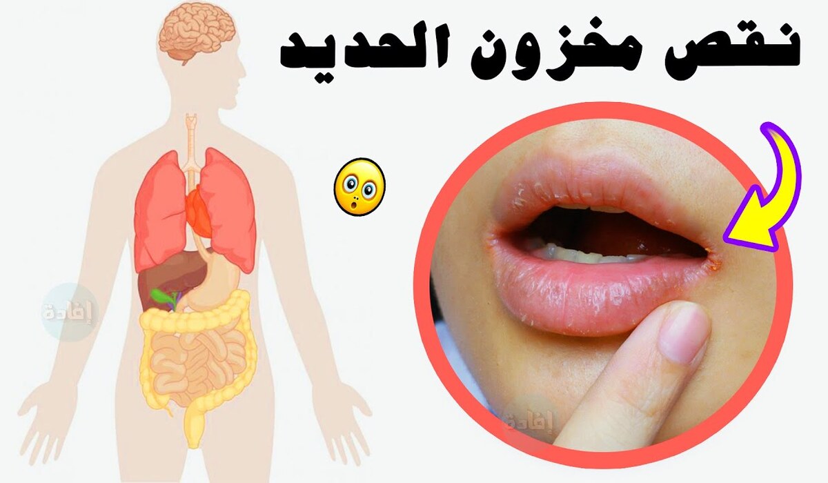 أعراض نقص الحديد في الجسم